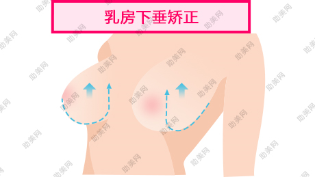 玻尿酸注射隆胸的优点有哪些