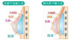 脂肪隆胸要多少钱？盘点