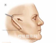 拉皮手术价格一览表2021年