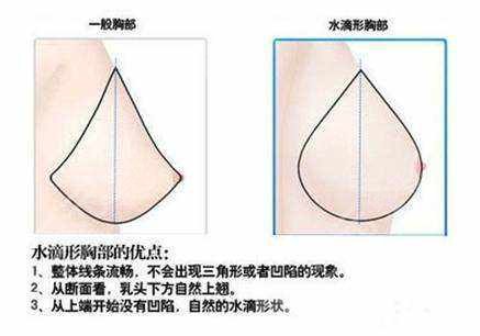 水滴型隆胸躺下后效果