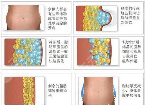 酷塑冷冻减脂的危害