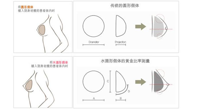 国产假体隆胸怎么样