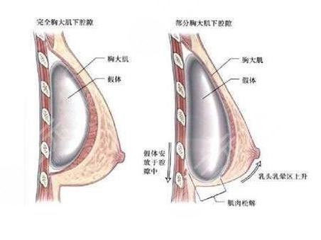 假体隆胸相关介绍
