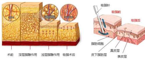 唐为东医生面部吸脂案例分享.jpg