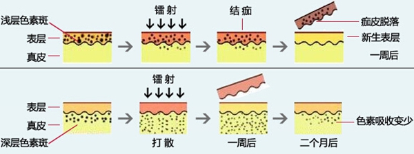 青岛华诺祛黄褐斑怎么样多少钱？