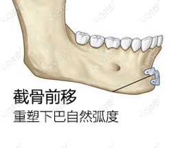 下巴截骨前移手术