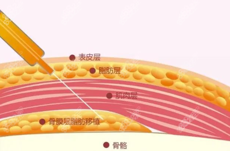 脂肪填充手术