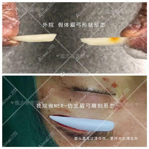 魏志香医生隆眉弓的眉头和眉尾假体过度自然.jpg