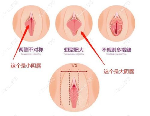 小阴唇和大阴唇的对比示意图.jpg