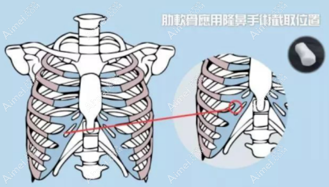 肋软骨隆鼻真实经历:肋骨吸收率不高,没出现鼻挛缩的后遗症