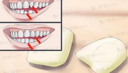 西安交大口腔医院牙科瓷贴面