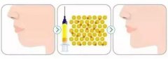 自体脂肪丰下巴有哪些优点