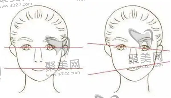 做完下颌角手术脸型不对称