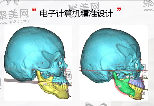 何晋龙正颌方案设计