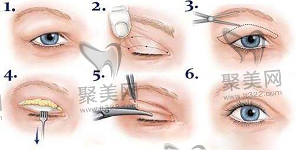 切开式双眼皮