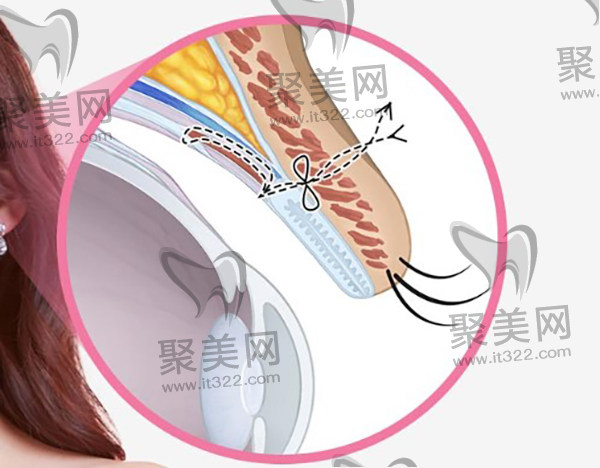 埋线双眼皮