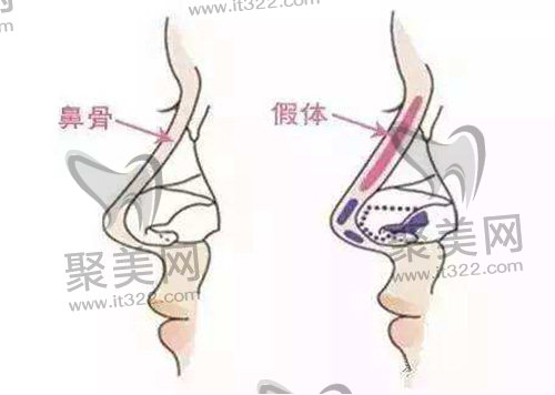 隆鼻手术示意图