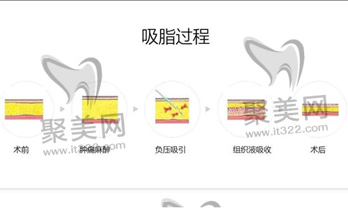 腰腹吸脂