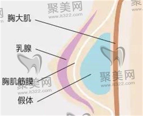 做了隆胸假体怎样判断移位了？想问隆胸假体躺下时滑动正常吗