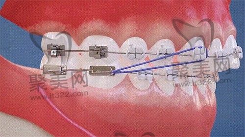 商丘中韩口腔牙齿矫正怎么样？金属托槽矫正性价比高技术奈斯