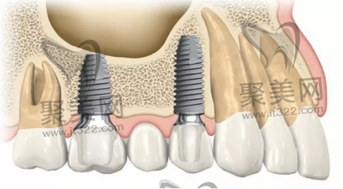 多颗牙种植怎么样