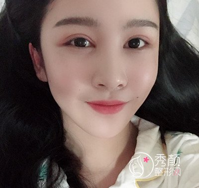 上海华美杨亚益割双眼皮开眼角恢复过程，7mm扇形真的很适合我！