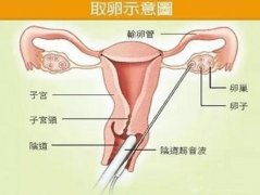 今日来谈谈长沙抽脂肪丰胸要多少钱