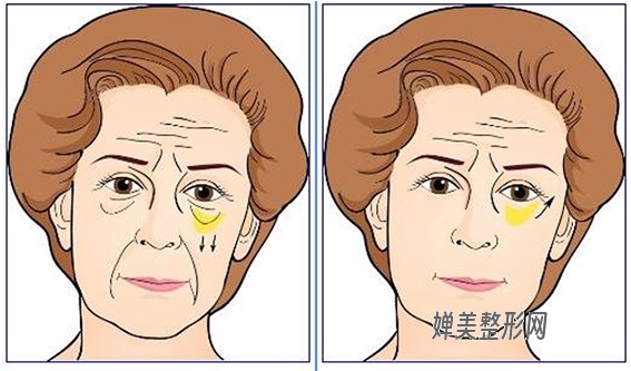 去眼袋的方法有哪些？内切去眼袋和外切去眼袋有什么区别？