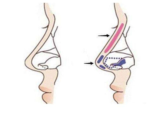 隆鼻的方法有哪些？自体软骨隆鼻有哪些优点？