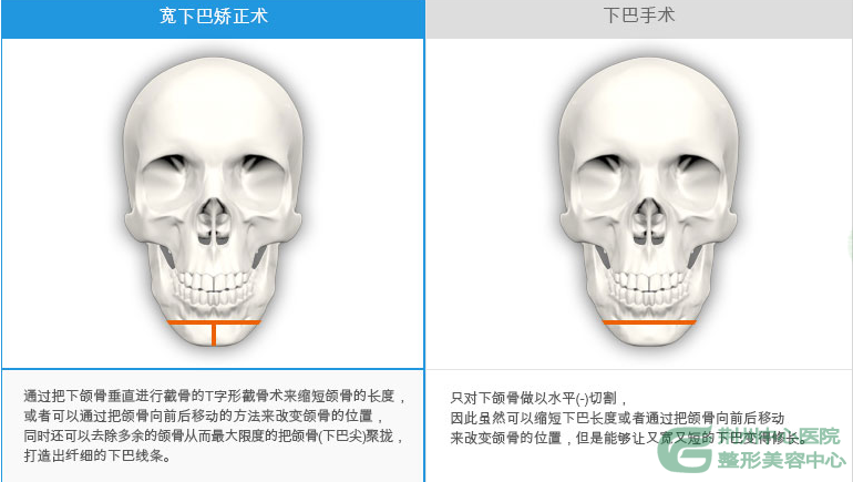 什么是宽下巴矫正术?