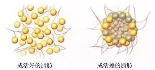 真正实现胸部“二次发育”，是填自体脂肪