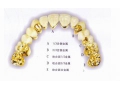 钛合金烤瓷牙怎么样