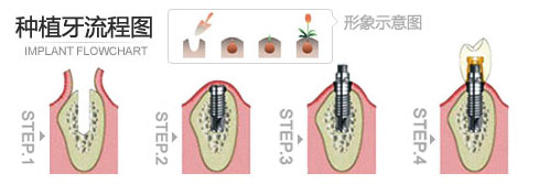 种植牙有什么危害