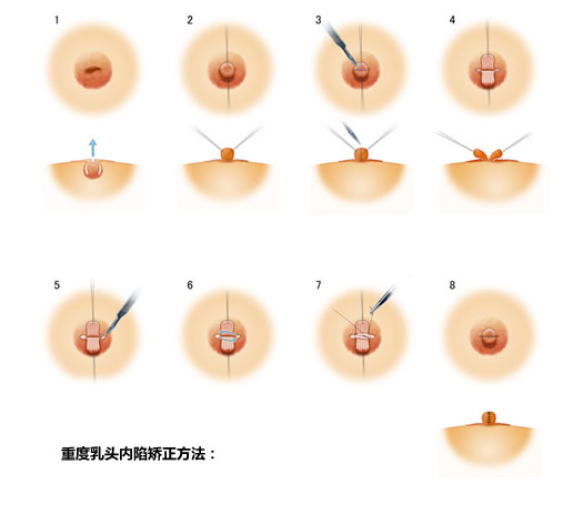 乳头内陷矫正安全性怎么样