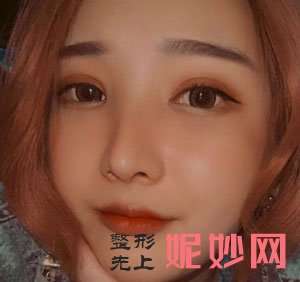 到上海华美找李志海做的V-LINE瓜子脸手术，术后40天脸精致又小巧