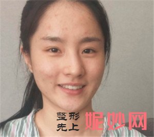 在北京正美医疗美容诊所找郑永生做的歪鼻矫正怎么样？真人案例分享！