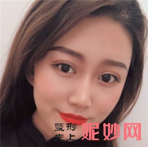 到北京杏林美找于红敏做自体脂肪面部填充，术后100天恢复效果非常好