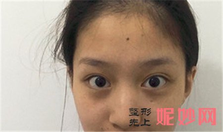 北京彤美的李长赋医生隆鼻技术怎么样？肋软骨隆鼻真人案例分享