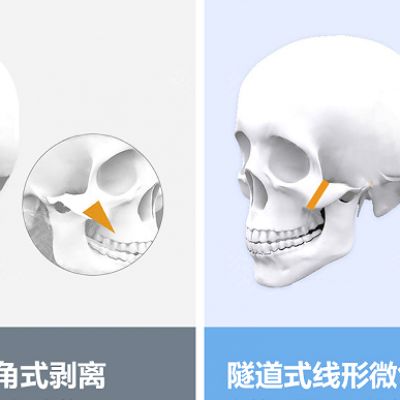 改脸型医生张笑天：颧骨内推为什么不容易出效果？保守原因是什么？