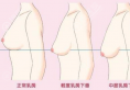 胸有点下垂适合做水滴假体比较自然,不推荐圆形假体哦