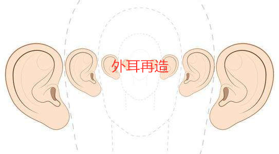 外耳再造手术