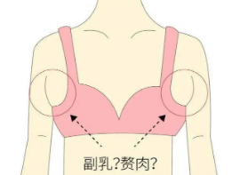 吸脂去副乳