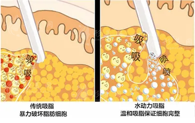 水动力吸脂手术效果怎么样？收费价格贵吗？