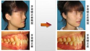 牙套矫正地包天效果怎么样