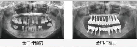 武汉德韩口腔医院全口种植牙案例CT对比效果