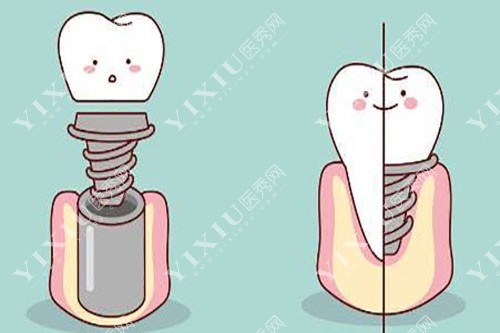 种植牙卡通示意图